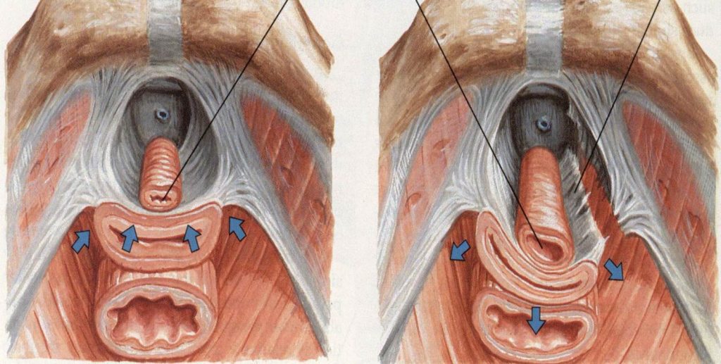 suzavanje-vaginalnog-ulaza-introitusa-rejuvinacija