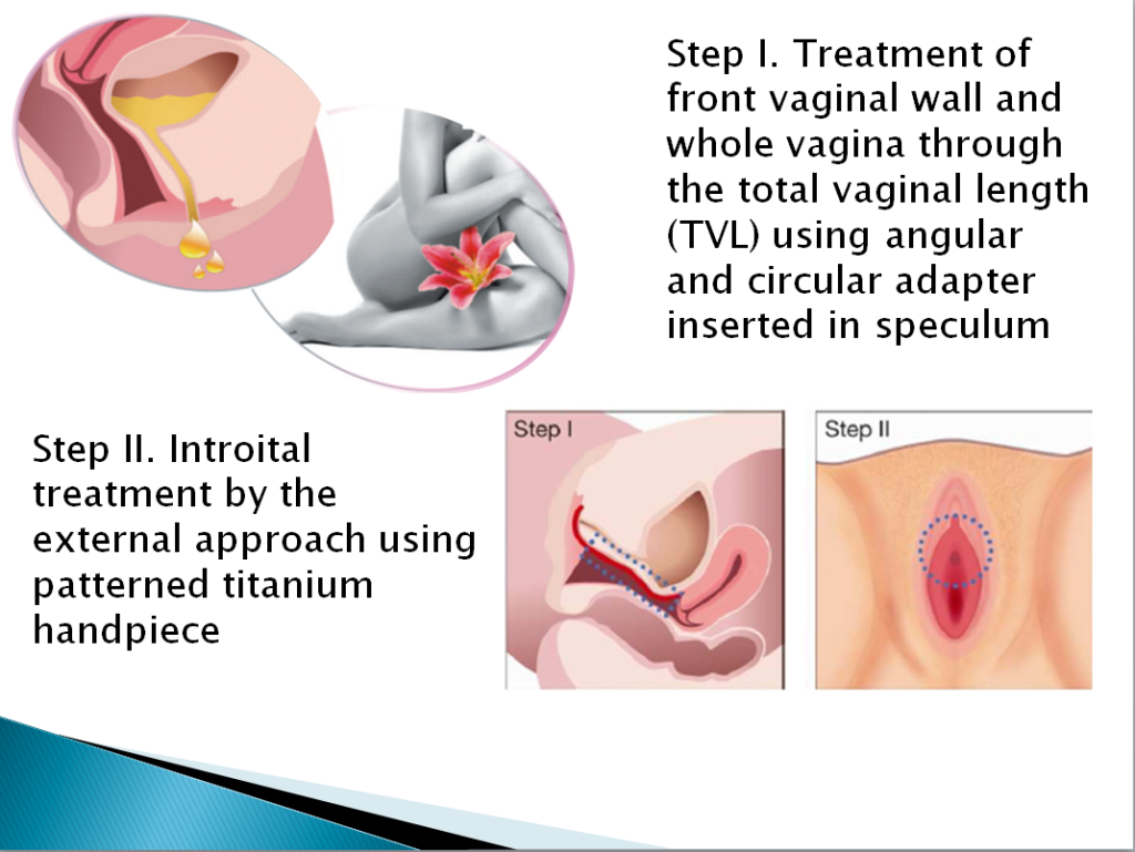 laserska-rejuvenacija-vagine