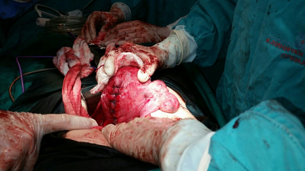 Rez na uterusu posle miomektomije