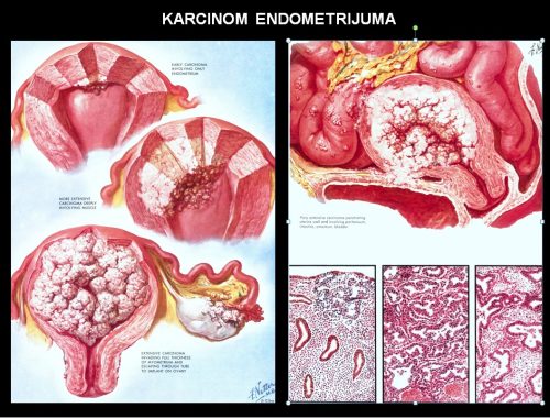 Karcinom endometrijuma