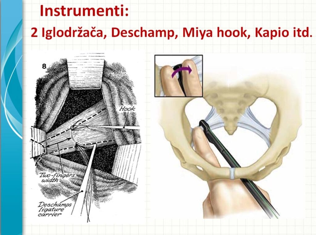 sakrospinalna kolposuspenzija nickols
